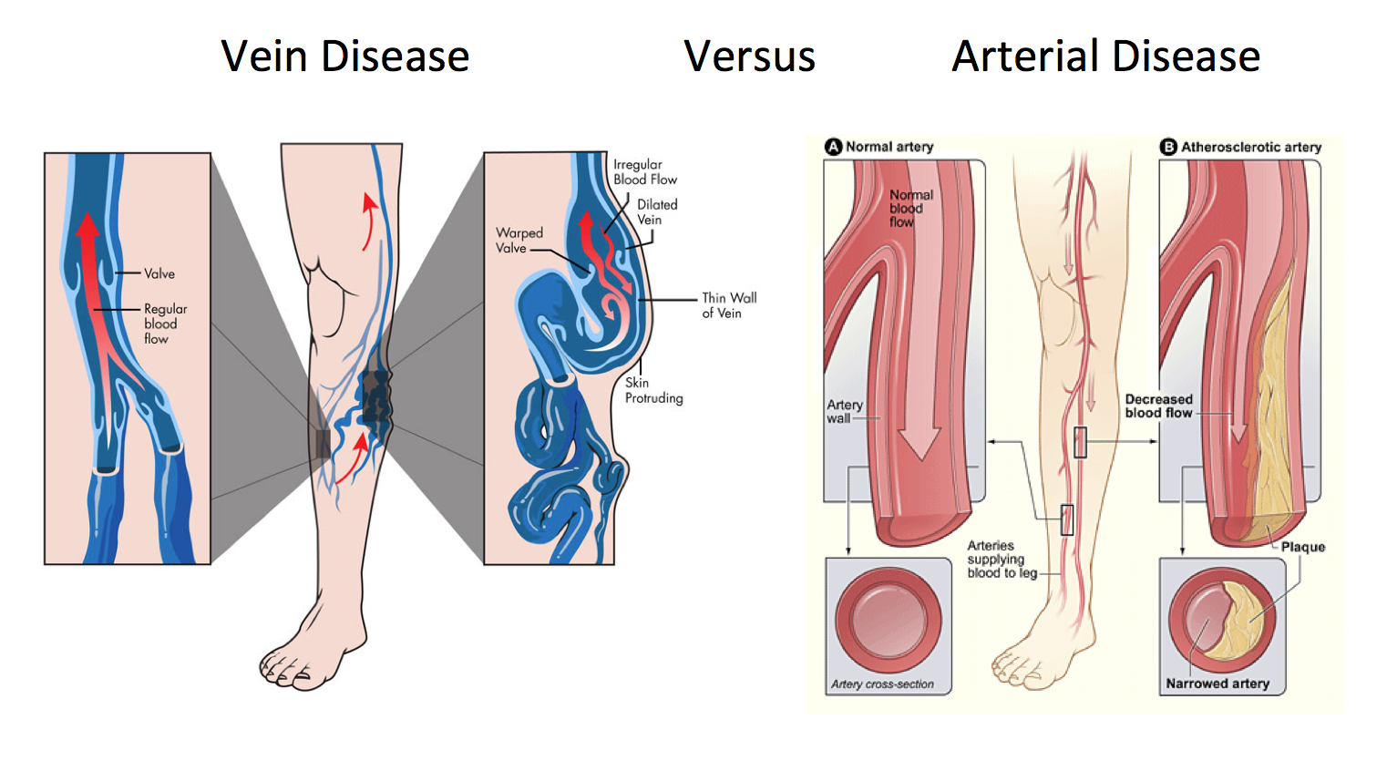 New York Vein Treatment Center Discuses Vein Diseases vs. Arterial